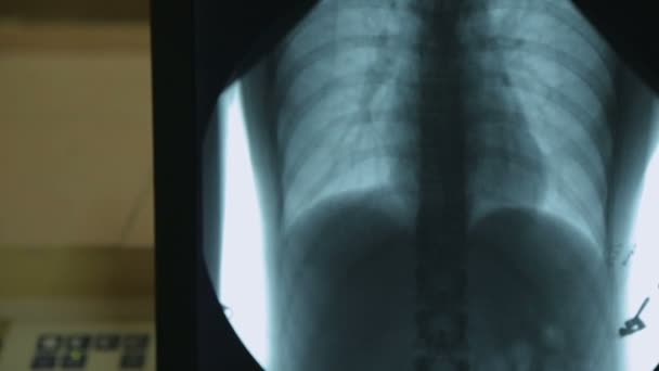 Радиолог рассматривает рентгеновские снимки пациентов с пневмонией, проводит лечение — стоковое видео
