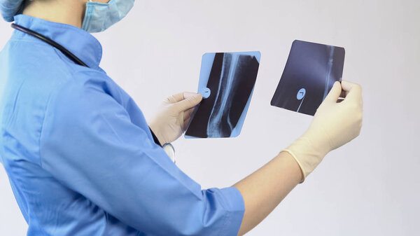 Doctor analyzing injured bones x-ray, making diagnosis, hospital surgery, job