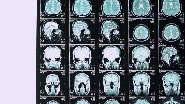 年轻神经外科医生对磁共振成像扫描患者脑震荡程度的计算 — 图库视频影像