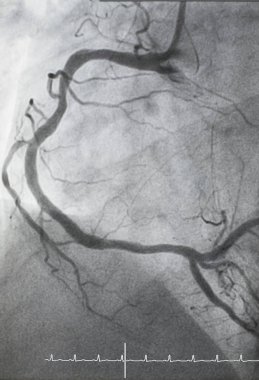 Coronary angiography , right coronary angiography, right coronary artery stenosis clipart