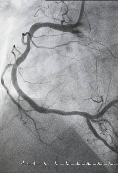 Coronary angiography , right coronary angiography, right coronary artery stenosis