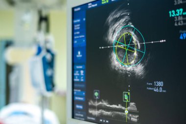Kardiyak kateterizasyon laboratuvarında damar içi ultrason görüntüleme (IVUS).