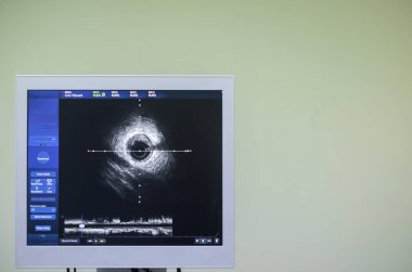 Kardiyak kateterizasyon laboratuvarında damar içi ultrason görüntüleme (IVUS).