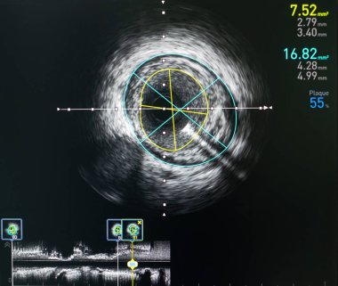 Kardiyak kateterizasyon laboratuvarında damar içi ultrason görüntüleme (IVUS).