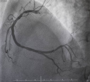 Coronary angiography , right coronary angiography clipart