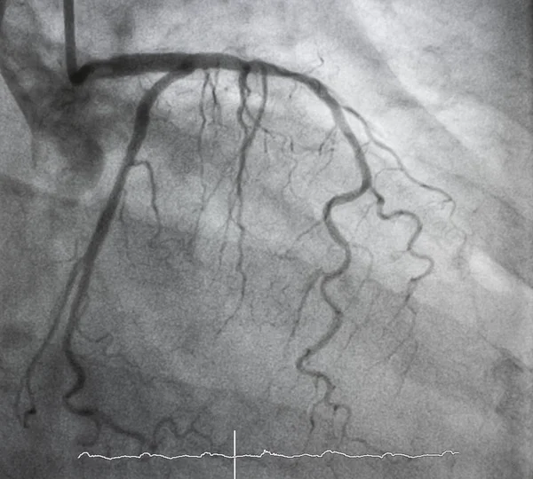 Angiografia Wieńcowa Angiografia Lewostronna — Zdjęcie stockowe