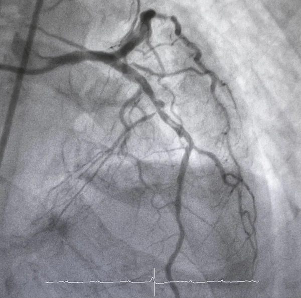 Angiografia Wieńcowa Angiografia Lewostronna — Zdjęcie stockowe