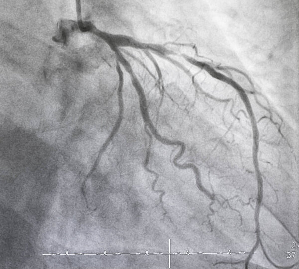 Coronary angiography , Left coronary angiography