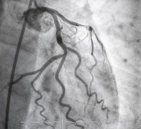 관상동맥 관상동맥 — 스톡 사진
