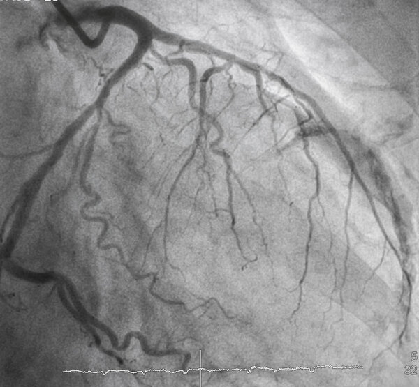 Coronary angiography , Left coronary angiography