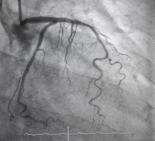 Coronary angiography , Left coronary angiography