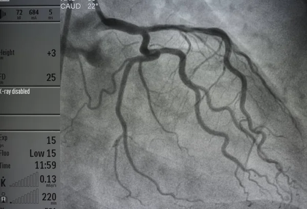 Koronární Angiografie Levá Koronární Angiografie — Stock fotografie