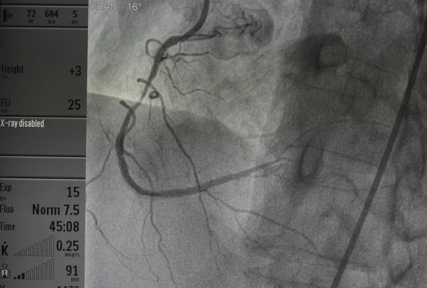 Koronarangiographie Rechte Koronarangiographie — Stockfoto