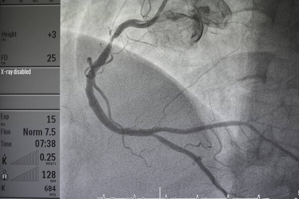 Коронарная ангиография, правая коронарная ангиография