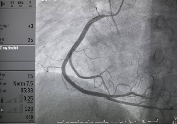 Coronary angiography , right coronary angiography
