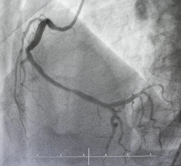 Angiographie Coronarienne Angiographie Coronarienne Droite — Photo