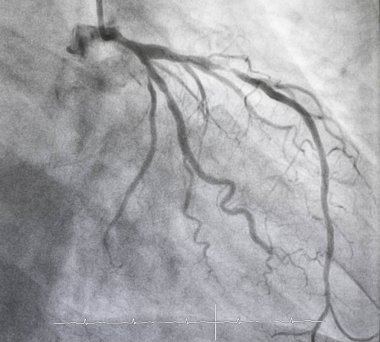 Coronary angiography , Left coronary angiography clipart