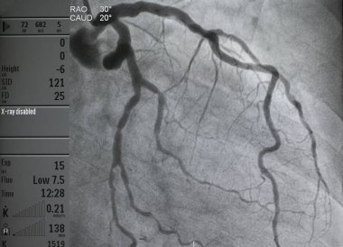 Coronary angiography , left coronary angiography clipart