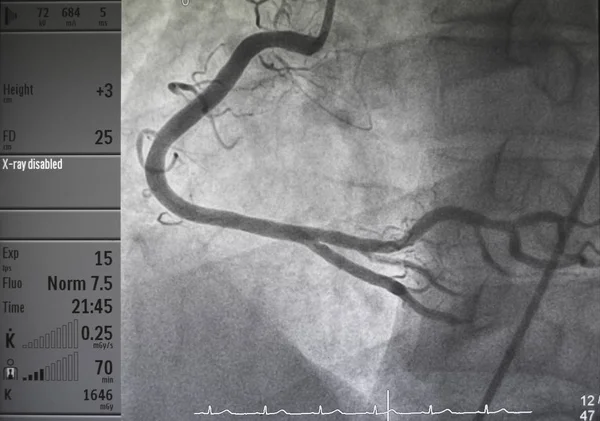 Koronar Angiografi Höger Koronar Angiografi — Stockfoto