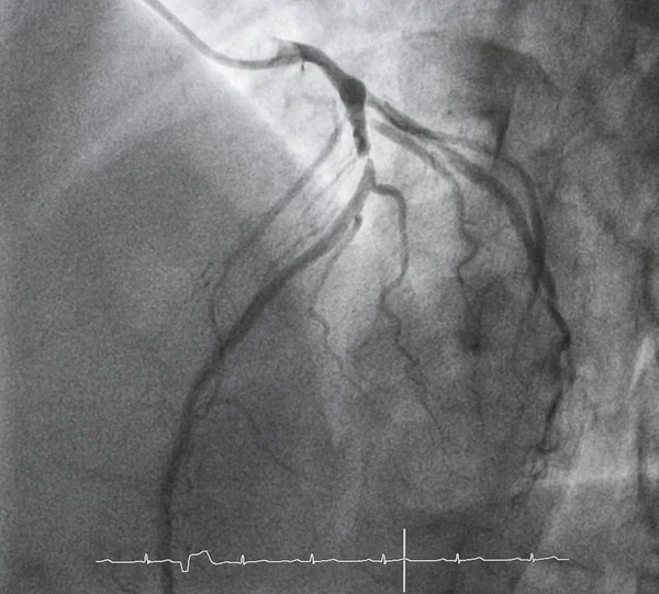 Angiografia Wieńcowa Angiografia Lewostronna — Zdjęcie stockowe