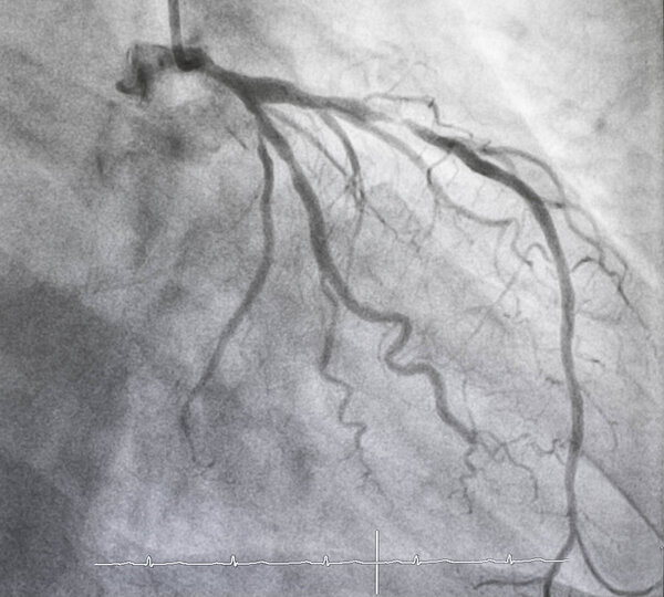 Coronary angiography , Left coronary angiography