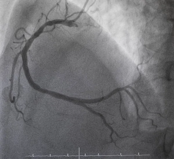 Koronární Angiografie Pravá Koronární Angiografie — Stock fotografie