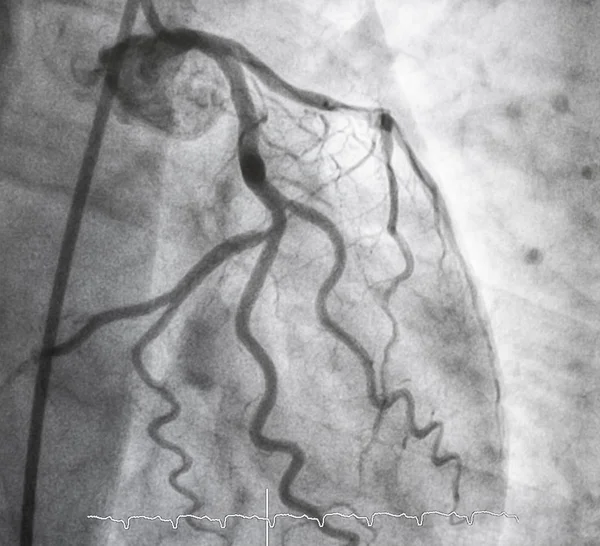 관상동맥 관상동맥 — 스톡 사진