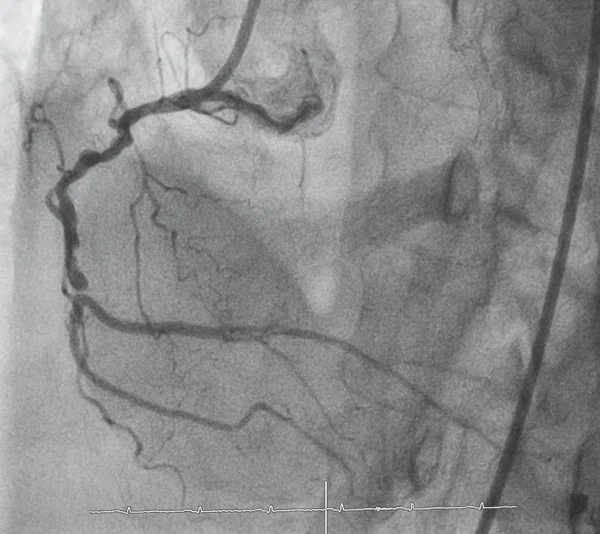 오른쪽 관상동맥 — 스톡 사진