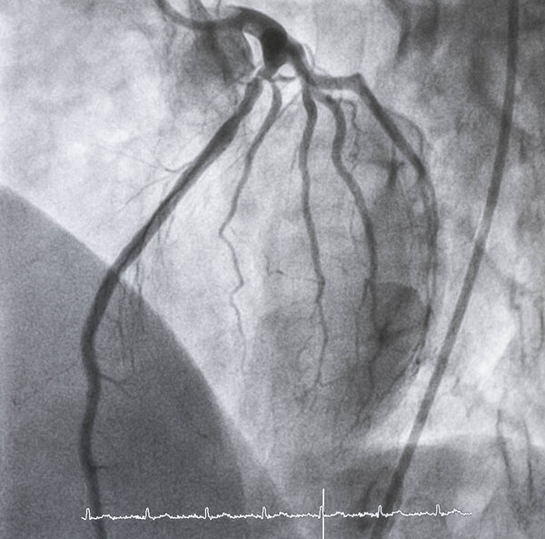 Coronary angiography , Left coronary angiography