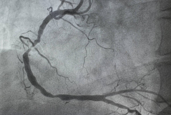 Коронарная ангиография, правая коронарная ангиография