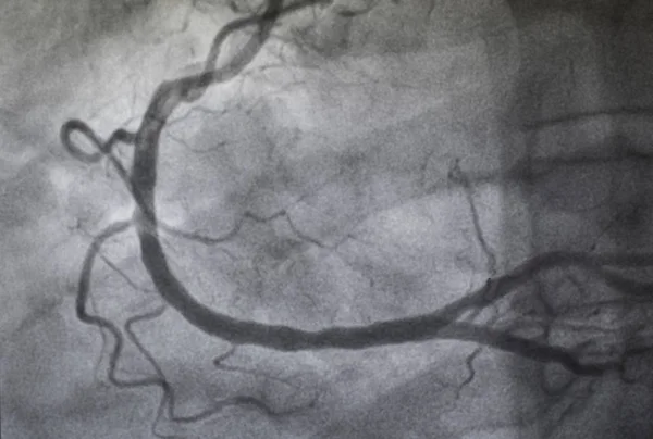 오른쪽 관상동맥 — 스톡 사진