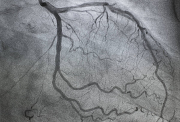 Coronary angiography , left coronary angiography