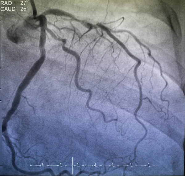 Angiografia Coronariana Angiografia Coronariana Esquerda — Fotografia de Stock