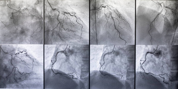 Coronary angiography , left and right coronary angiography