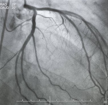 Coronary angiography , left coronary angiography clipart