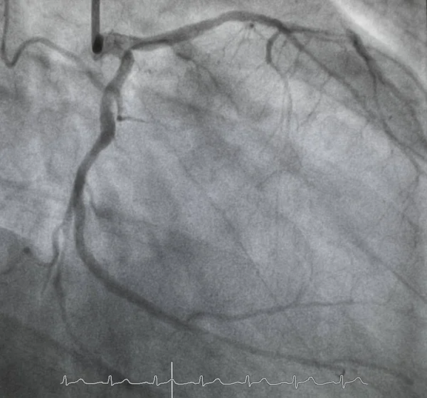 Angiographie Coronarienne Angiographie Coronarienne Gauche — Photo