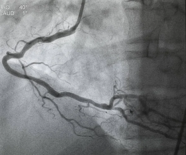 Angiografia Coronariana Angiografia Coronária Direita — Fotografia de Stock