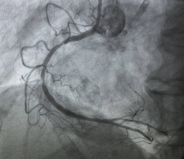 Coronary angiography , right coronary angiography