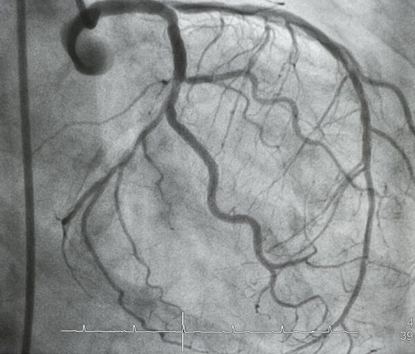 Coronary angiography , left coronary angiography