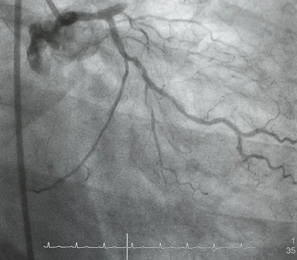 Angiografia Wieńcowa Angiografia Lewostronna — Zdjęcie stockowe