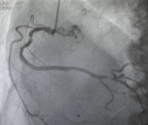 Coronaire Angiografie Rechter Coronaire Angiografie — Stockfoto