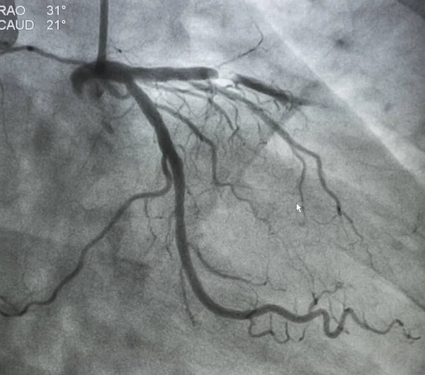 Angiografia Wieńcowa Angiografia Lewostronna — Zdjęcie stockowe