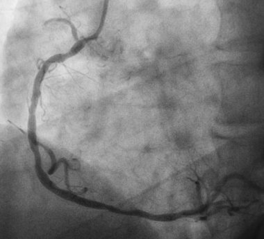 Koroner anjiyografi, sağ koroner anjiyografi.