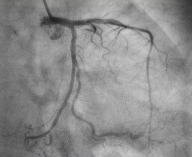 Koroner anjiyografi, sol koroner anjiyografi.