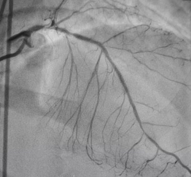 Koroner anjiyografi, sol koroner anjiyografi.