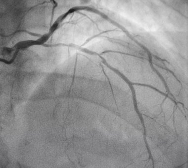 Koroner anjiyografi, sol koroner anjiyografi.