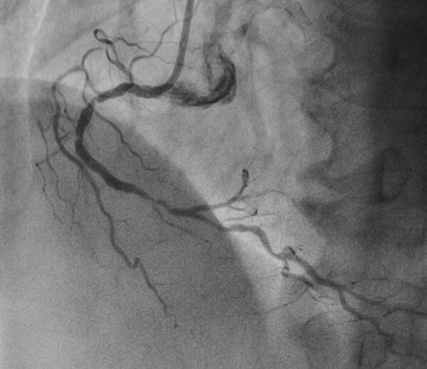 Коронарная ангиография, правая коронарная ангиография
