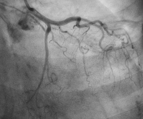 Коронарная ангиография, левая коронарная ангиография
