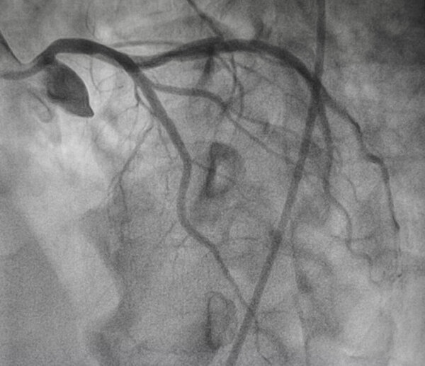 Коронарная ангиография, левая коронарная ангиография
