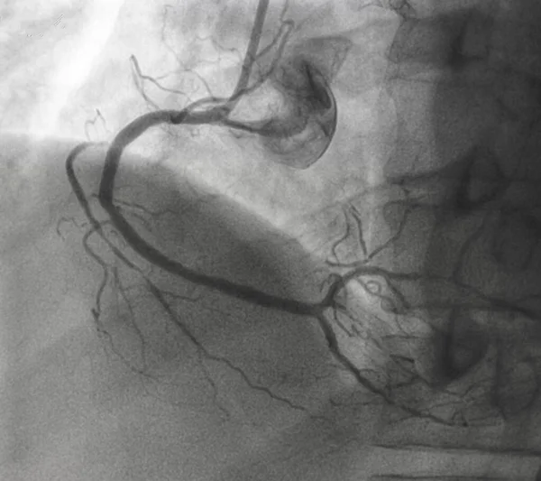 Angiografía Coronaria Coronariografía Derecha — Foto de Stock